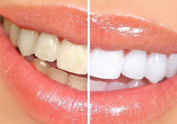 Zakaj beliti zobe?